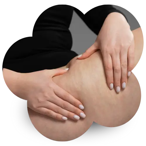 Frau massiert Oberschenkel zur Unterstützung der Cellulite- und Lipödem-Behandlung im Stadium 1